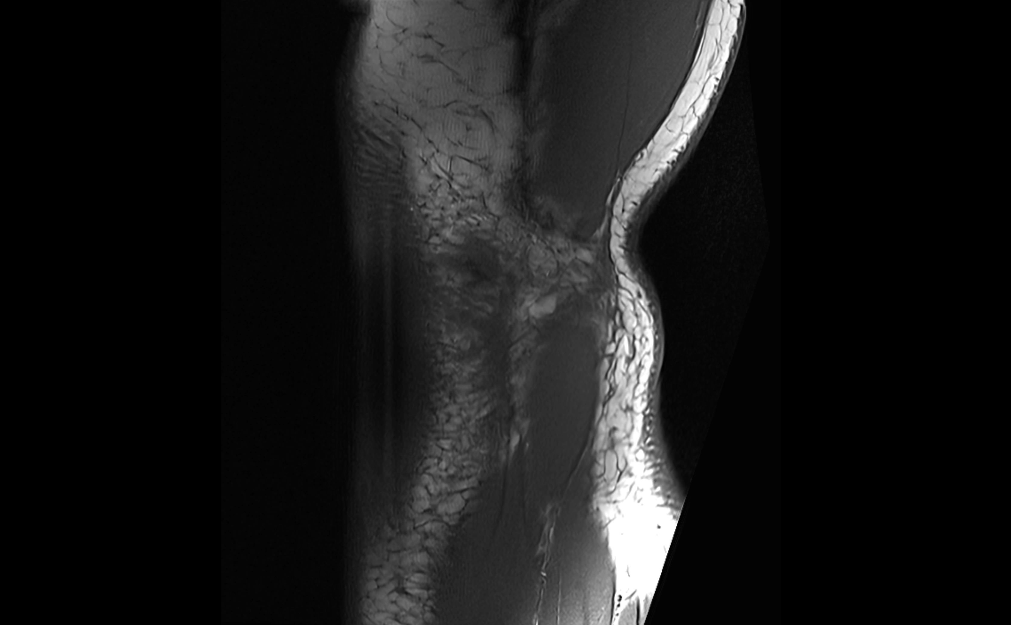 MRI elbow ligaments coronal cross sectional anatomy 3T  radiology  image-img-07001-00031.webp